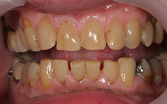 Closeup of yellowed decayed teeth
