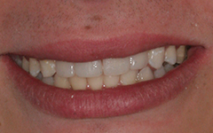 Closeup of front teeth with discoloration removed