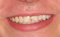 Closeup of front teeth with discoloration
