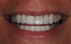 Closeup of smile with healthy white bottom teeth