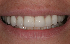 White and healthy smile after