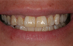 Unhealthy yellowed teeth