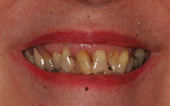 Closeup of severely decayed and damaged teeth