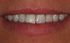 Closeup of smile with yellowing around teeth