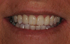 Flawlessly repaired front tooth