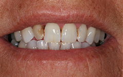 Front tooth with severe decay or damage