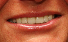 Closeup of straight healthy smile