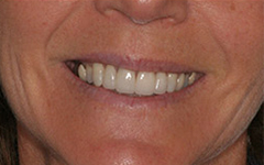Closeup of healthy beautiful teeth after repair
