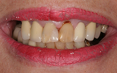 Closeup yellowed front tooth and damaged gums