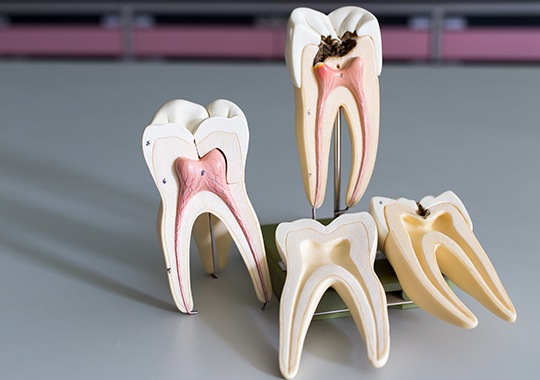 Model of healthy and unhealthy tooth