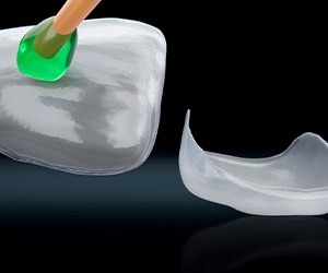 Image of dental veneers 
