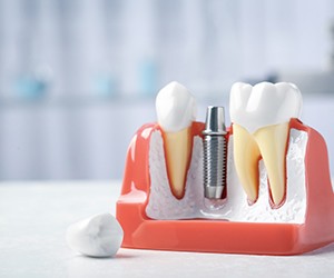 Close-up of a model of a dental implant in Hammonton, NJ