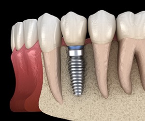 Illustration of dental implant in Hammonton, NJ with crown