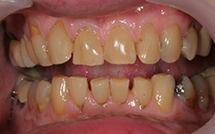 Closeup of yellowed decayed teeth