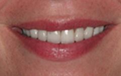 Closeup of bright white smile