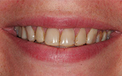 Closeup of yellowed teeth