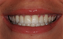 Closeup of white and healthy teeth