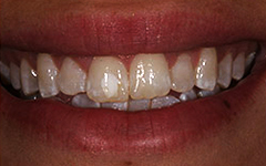 Closeup of yellow and worn teeth