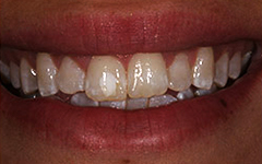 Closeup of yellow and worn teeth
