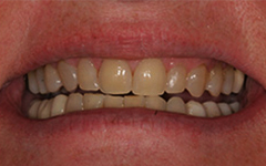 Yellowing and worn teeth closeup