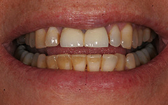 Closeup of yellowed bottom teeth