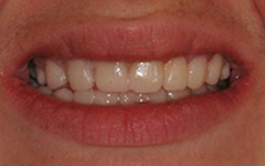 Closeup of flawlessly repaired smile