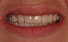 Closeup of flawlessly repaired smile