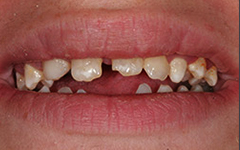 Closeup of cracked and brokent teeth