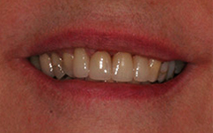 Closeup of flawlessly repaired smile