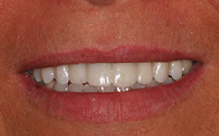 Closeup of brilliant white smile