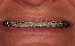 Closeup of teeth with braces