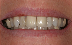 Closeup of teeth with yellowing around the edges