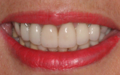Closeup of brilliantly repaired front teeth