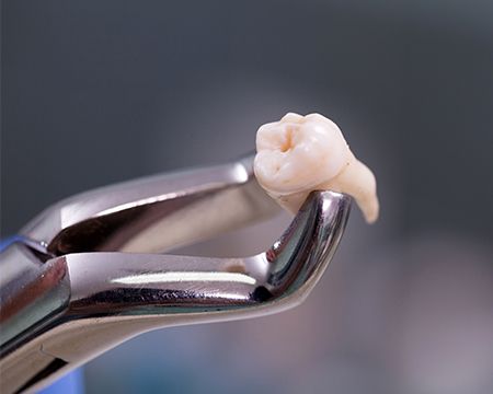 Metal clasp holding extracted tooth