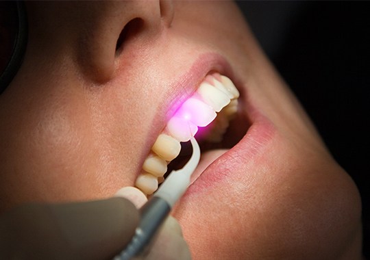Closeup of smile during laser gum disease treatment