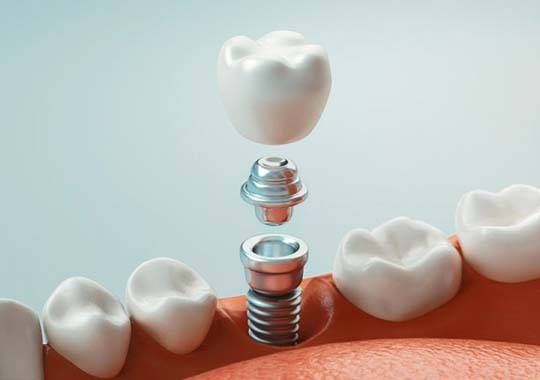 single dental implant with a crown