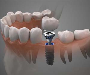 single dental implant supporting a crown