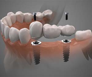 two dental implants supporting a bridge