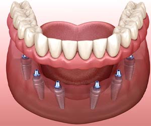 six dental implants supporting a denture