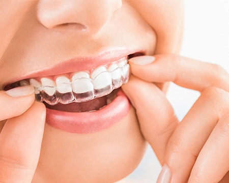 Closeup of patient placing Invisalign tray