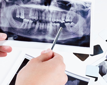 Dental x-rays showing missing teeth