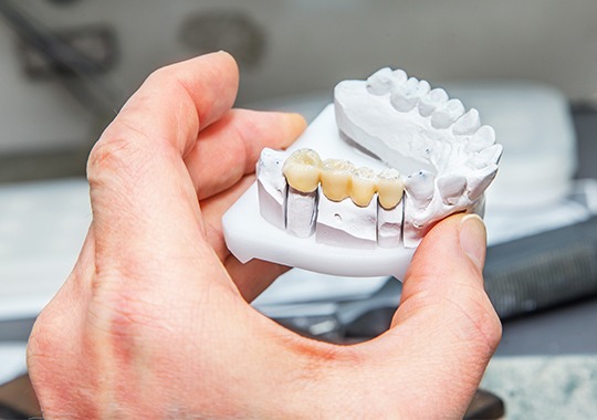 Model smile with fixed bridge restoration