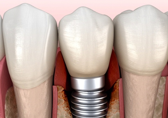 Close-up of failed dental implant in Hammonton, NJ