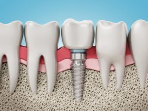 dental implant 3D illustration 