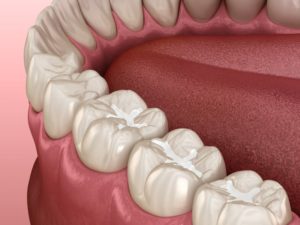 molar fissure dental fillings