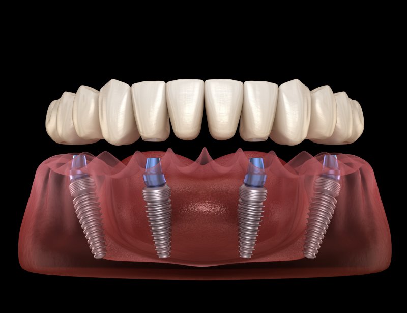 digital image of an implant denture