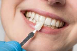 Dentist comparing a veneer to a patient’s natural teeth