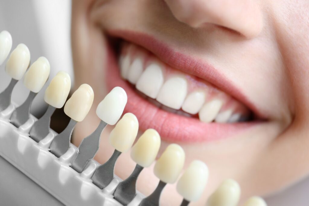 Closeup of a smile with shade guide held to teeth